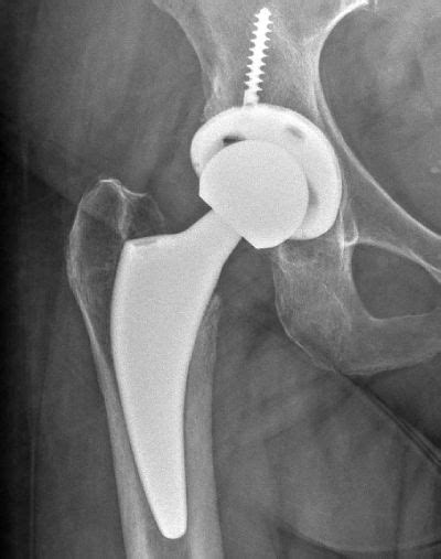 – A team of orthopedic <b>surgeons</b> at New England Baptist Hospital (NEBH) performed the first-ever augmented reality (AR)-guided total <b>hip</b> <b>replacement</b> at a hospital. . Doctors who perform superpath hip replacement